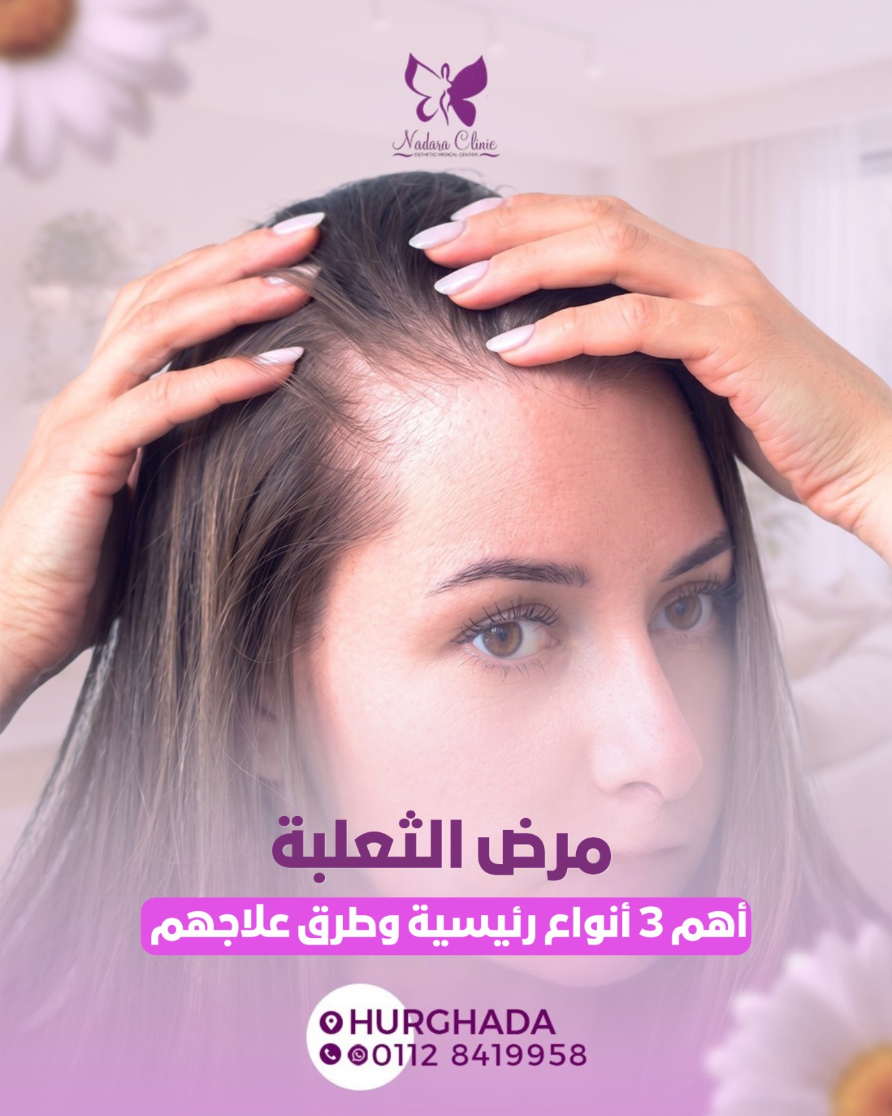 مرض الثعلبة؛ أهم 3 أنواع رئيسية وطرق علاجهم